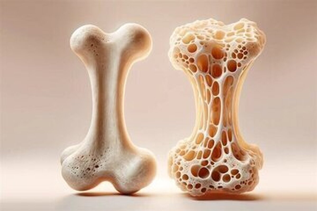 O nouă descoperire în întărirea oaselor poate inversa osteoporoza